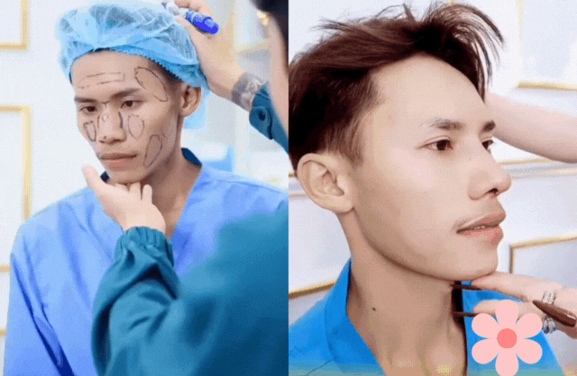 Lai Thai cũng tiêm chất làm đầy để khắc phục tình trạng gương mặt hốc hác, khắc khổ